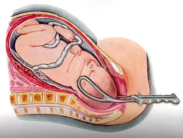 Introducción del fórceps