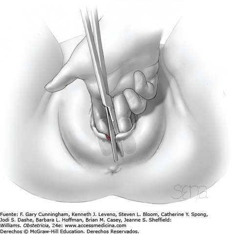 Episiotomía profiláctica