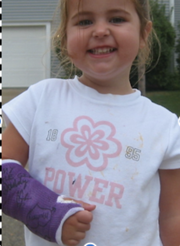 Mi primer hueso roto