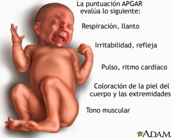 Sistema de puntuación de estado neonatal: Apgar