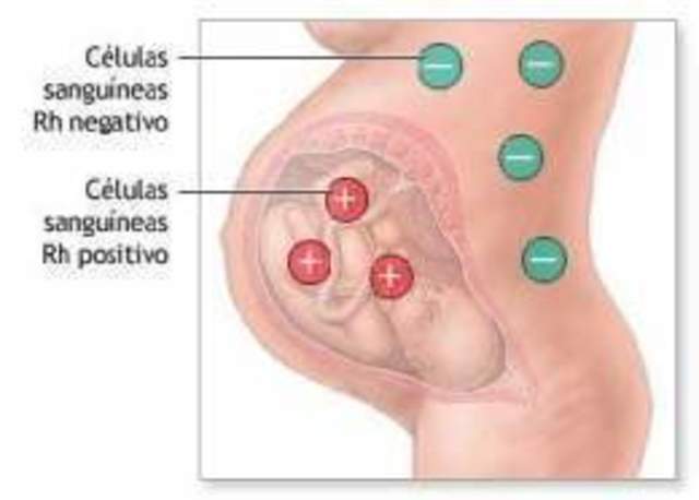 Transfusión intrauterina por enfermedad hemolítica