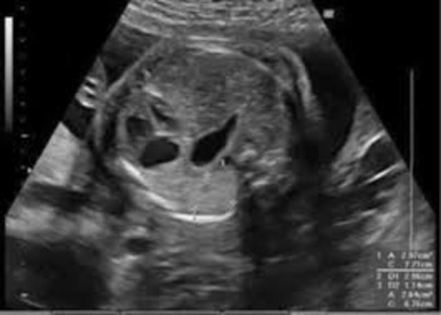 Primera cirugía abierta en feto humano (hidroureteronefrosis)