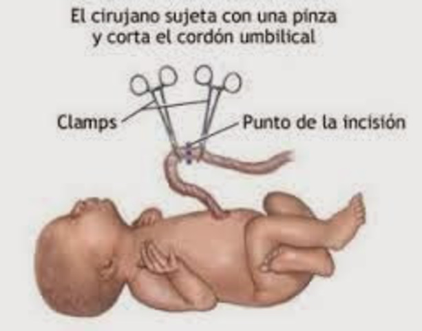 Primera ligadura endoscópica cordón umbilical