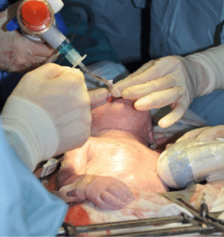 Procedimiento Exit (ex – utero intrapartum theraphy)