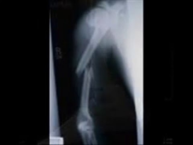 Broken bones