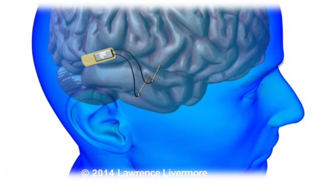 IMPLANTES DE MEMORIA