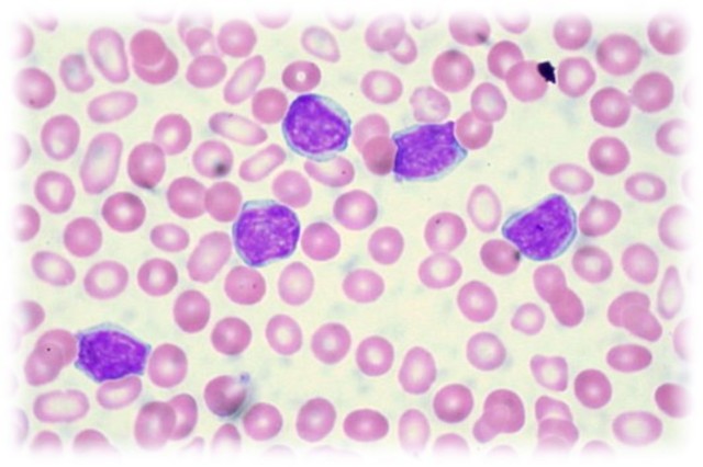 LA TERAPIA GÉNICA CONTRA LA LEUCEMIA