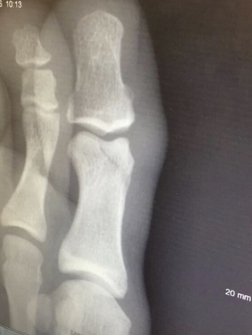 Broken Toe