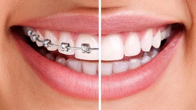 2014 - Me ponieron frenillos