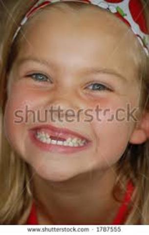 se me cayeron los 2 dientes del frente