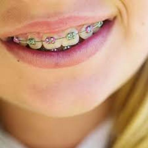 Me pusieron a me en frenillos.