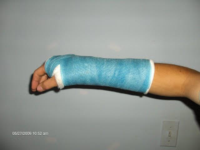 BROKEN ARM