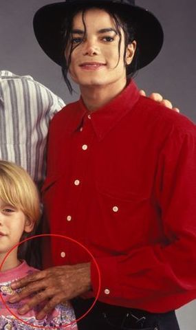 Jackson has Vitiligo