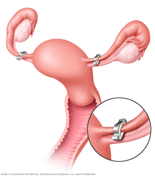SIGLO XX: LIGADURA DE TROMPAS