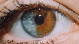 Timeline: Heterchromia