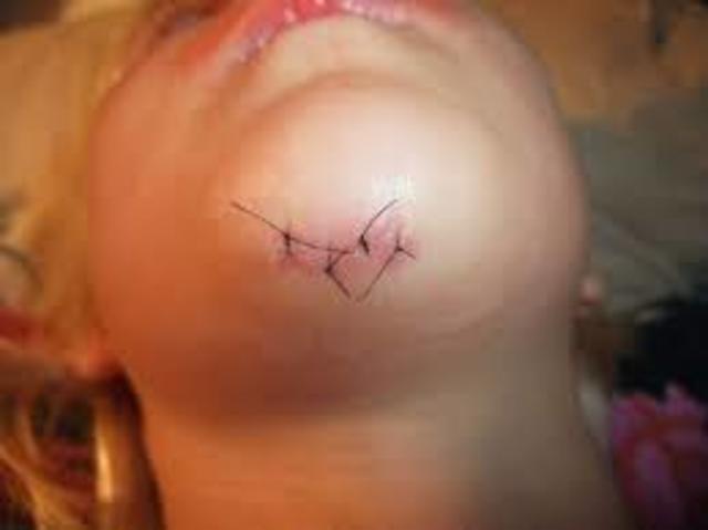 First Stitches :(