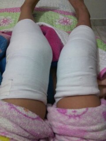 Mi cirugía./ My surgery.