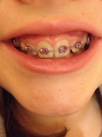 BRACES