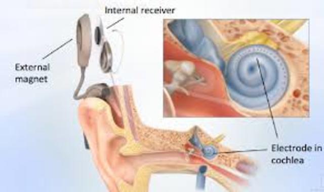 First Successful Cochlear Implant