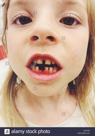 lost first tooth