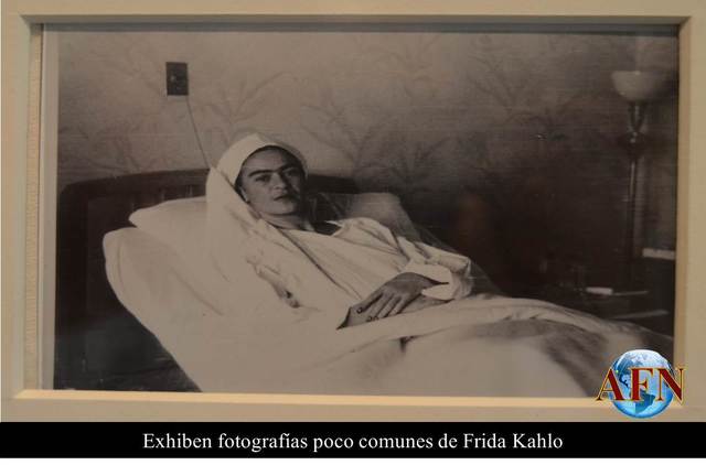 Parte de la pierna de Frida es amputada.