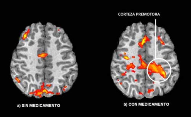 Resonancia magnética funcional (FMRI) y  la tomografía por emisión de positrones (PET)