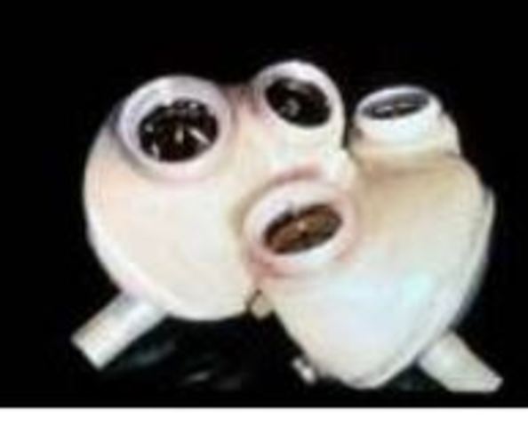 1st ventricular assist device