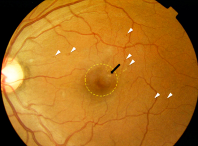 Development and Validation of a Deep Learning Algorithm for Detection of Diabetic Retinopathy in Retinal Fundus Photographs