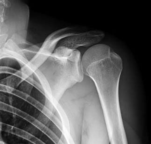 Fractura de hombro izquierdo  (luxación).