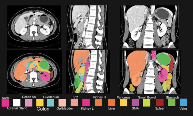 The project artificial intelligence that is used to identify tumors.