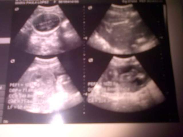 Embarazo de mi hermana