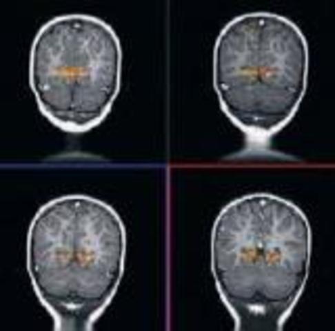 RESONANCIA  MAGNÉTICA  FUNCIONAL