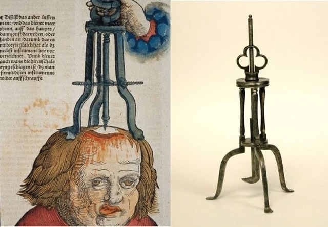 Trepanación