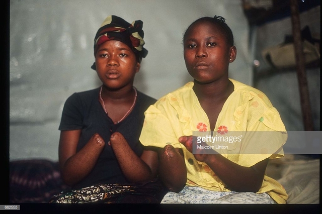 Mariatu reunited with her cousin, Adamsay at the hospital