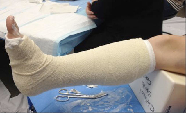 Yo me rompe mi pierna cuando yo juge futbol.