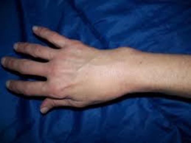 Yo rompi mi muneca el rato snowboard.