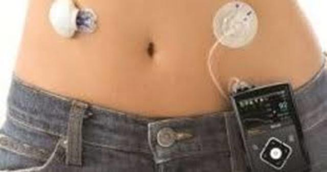 The first artificial pancreas was created