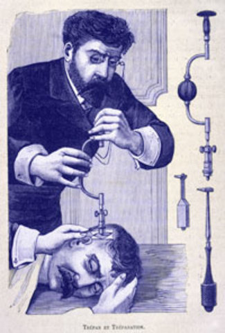 Trepanación