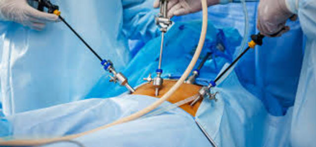 Laparoscopic Surgery's