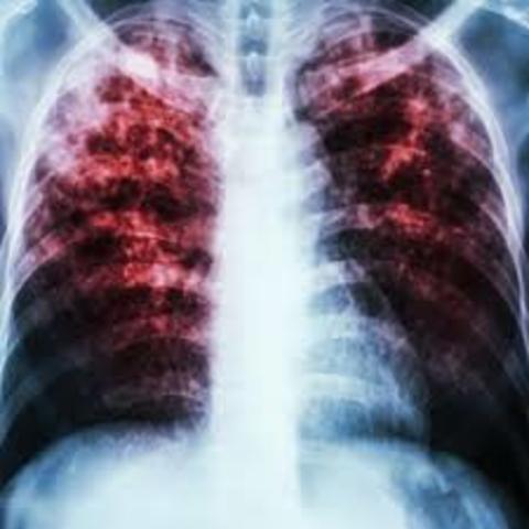 Tuberculosis