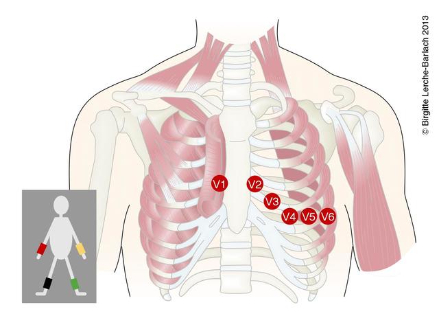 Derivaciones precordiales V1 a V6
