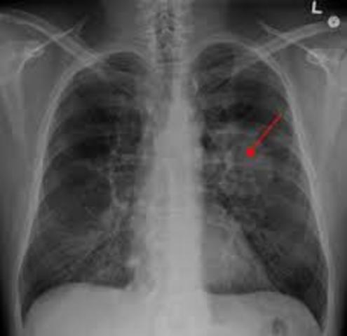 Baba's lung cancer and eventually death