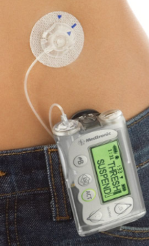 Insulin Pump Invention