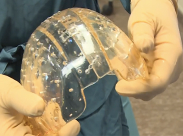 First 3-D Skull Transplant