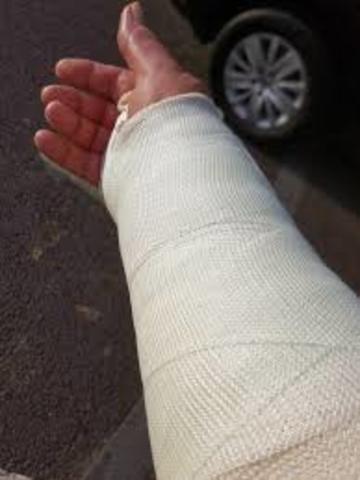broke my arm