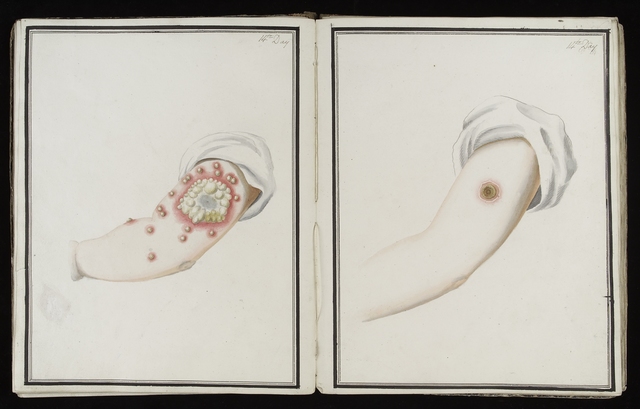 Inoculation for Smallpox was created