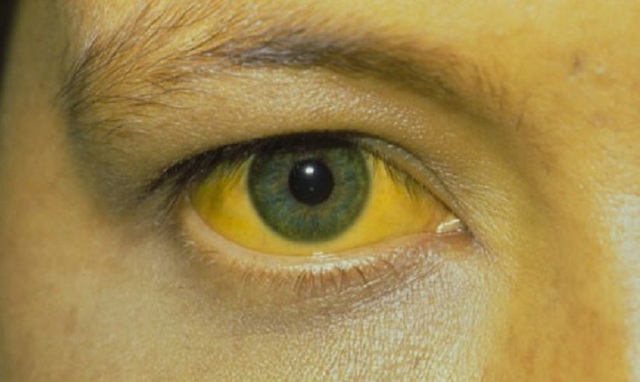 Yellow fever spreads