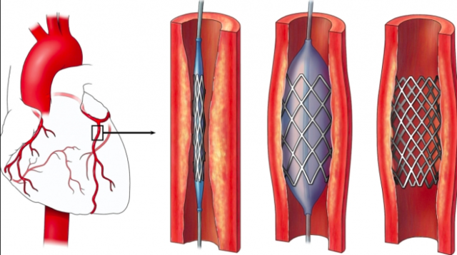 First ballon angioplasty procedure on a coronary artery