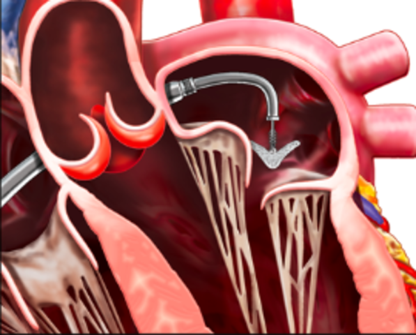 Invention of the Mitraclip