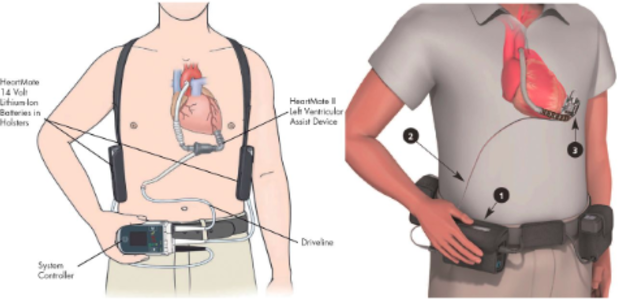 Creation of the Left-Ventricular Assist Device